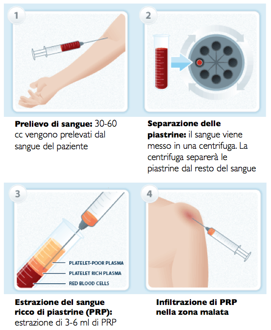 prp preparazione